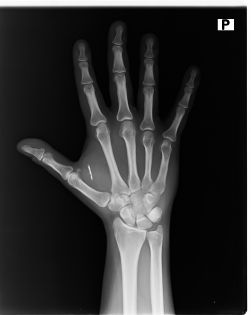 NeXT v pravé ruce, pozice R0, rentgenový snímek